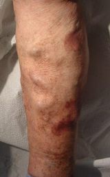 vein disease